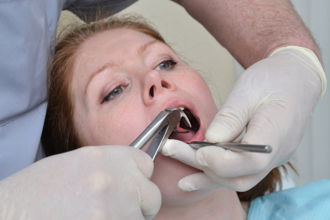 tooth-extraction-prep-your-painless-guide